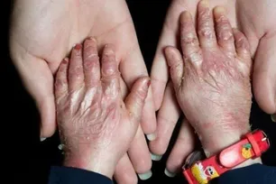 Health insurance provided for some 2m patients with rare, hard-to-treat diseases