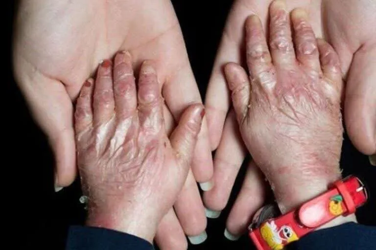 Health insurance provided for some 2m patients with rare, hard-to-treat diseases